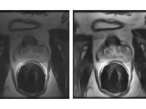 Multi-Resolution Level Sets with Shape Priors: A Validation Report for 2D Segmentation of Prostate Gland in T2W MR Images